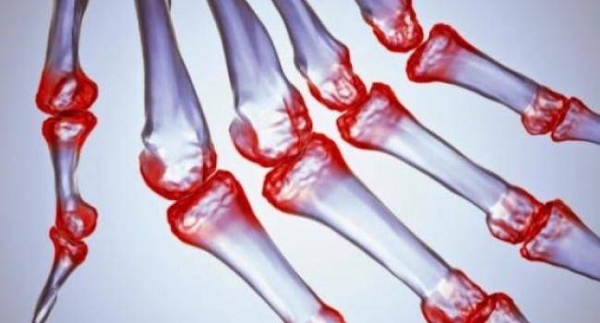 9 ранних признаков ревматоидного артрита